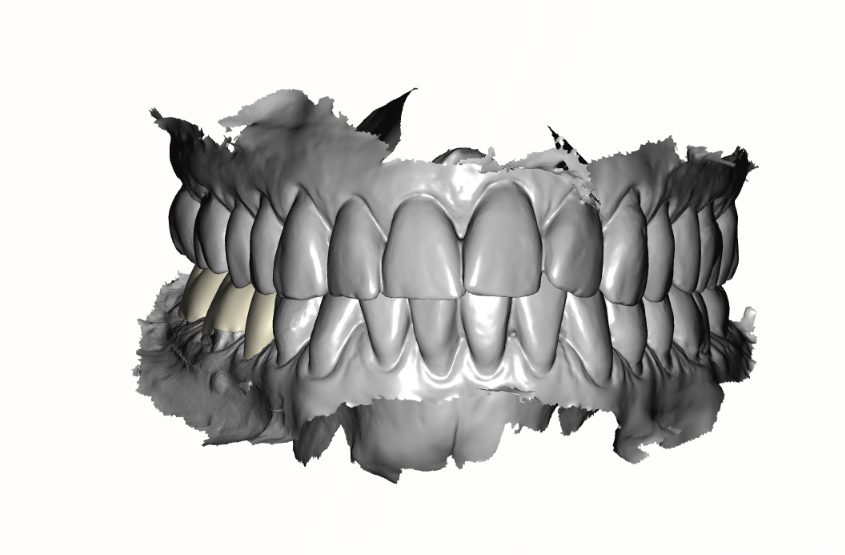 3-Unit Zirconia Bridge — frontal view