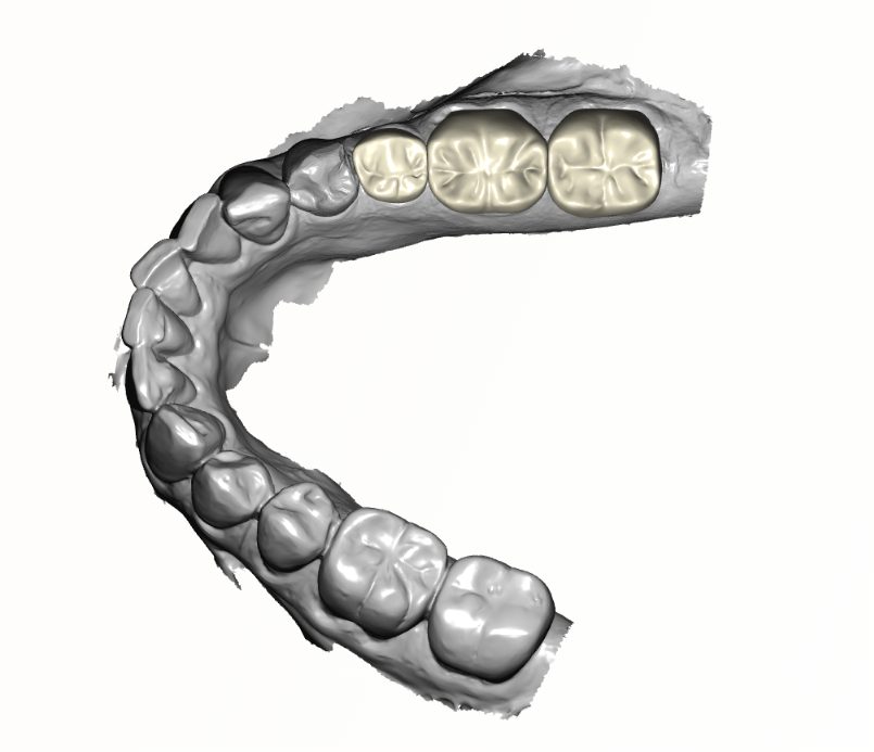 3-Unit Zirconia Bridge case thumbnail