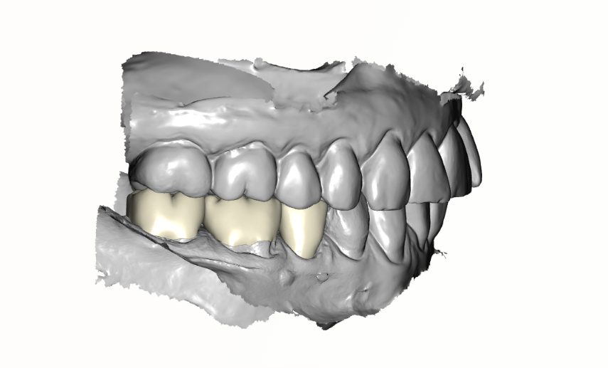 3-Unit Zirconia Bridge — side view
