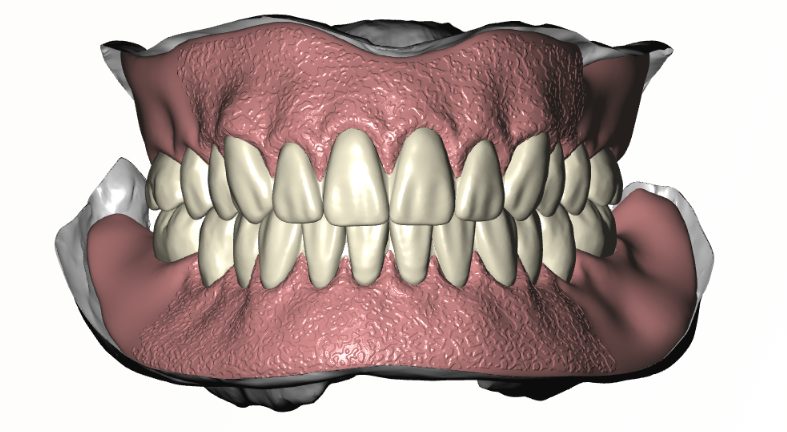 Digital Denture Setup case thumbnail
