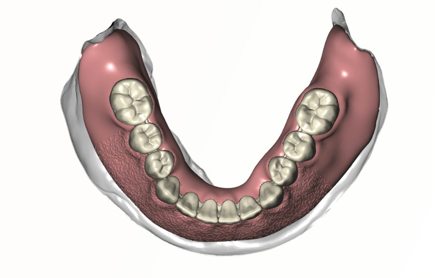 Digital Denture Setup — occlusal lower arch view
