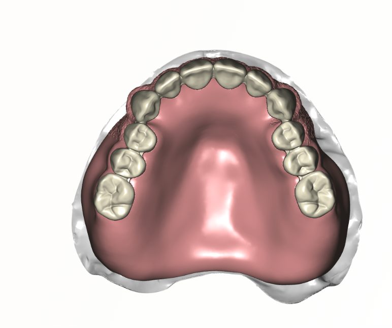 Digital Denture Setup — occlusal view