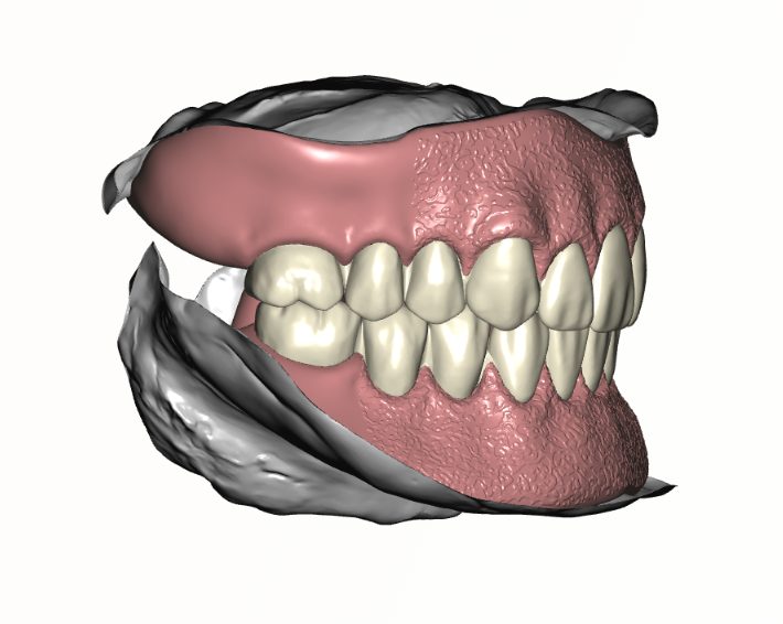 Digital Denture Setup — side view