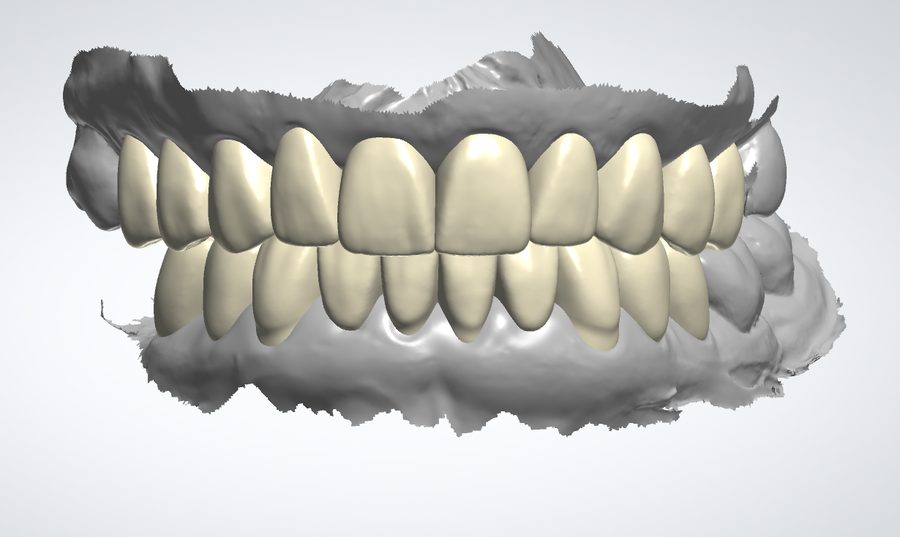 Digital Smile Design case thumbnail