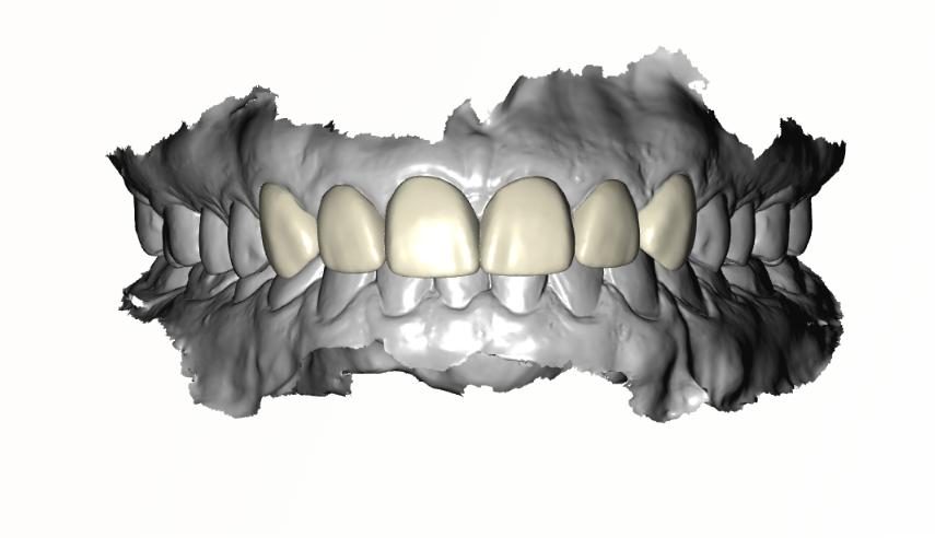 Full Zirconia Crowns — frontal view