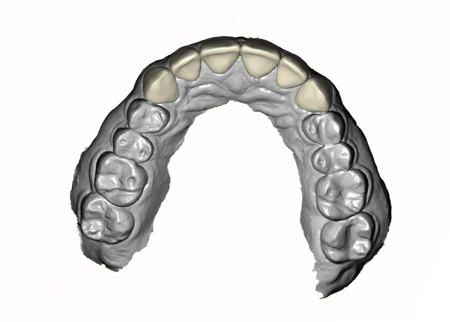 Full Zirconia Crowns case thumbnail