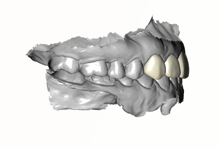 Full Zirconia Crowns — side view