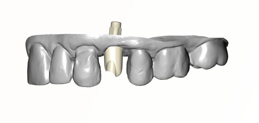Screw-Retained Crown — frontal abutment view