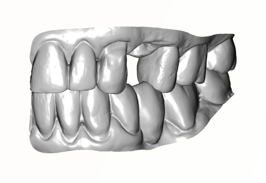 Screw-Retained Crown case thumbnail