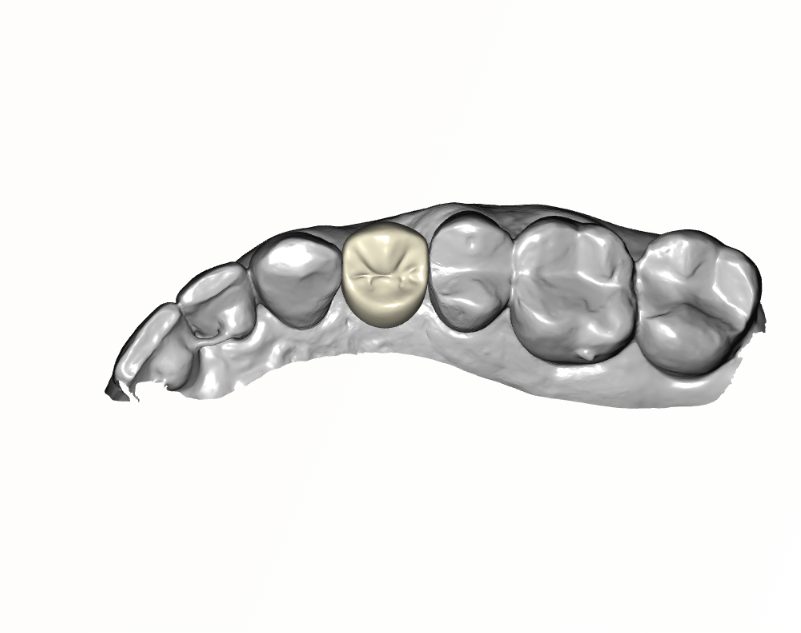 Screw-Retained Crown — occlusal view