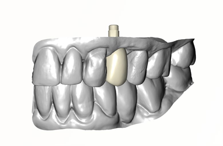 Screw-Retained Crown — side view